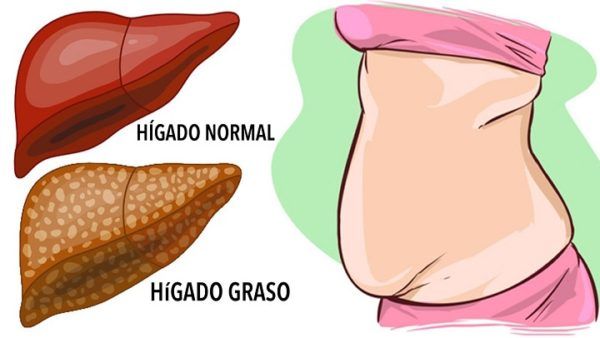 Hígado Graso